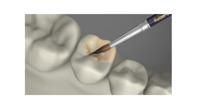 Metal içermeyen Veneerleme