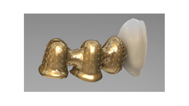 Metal Destekli Veneerler