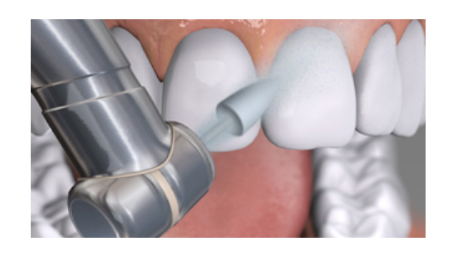 Restoratif Materyaller