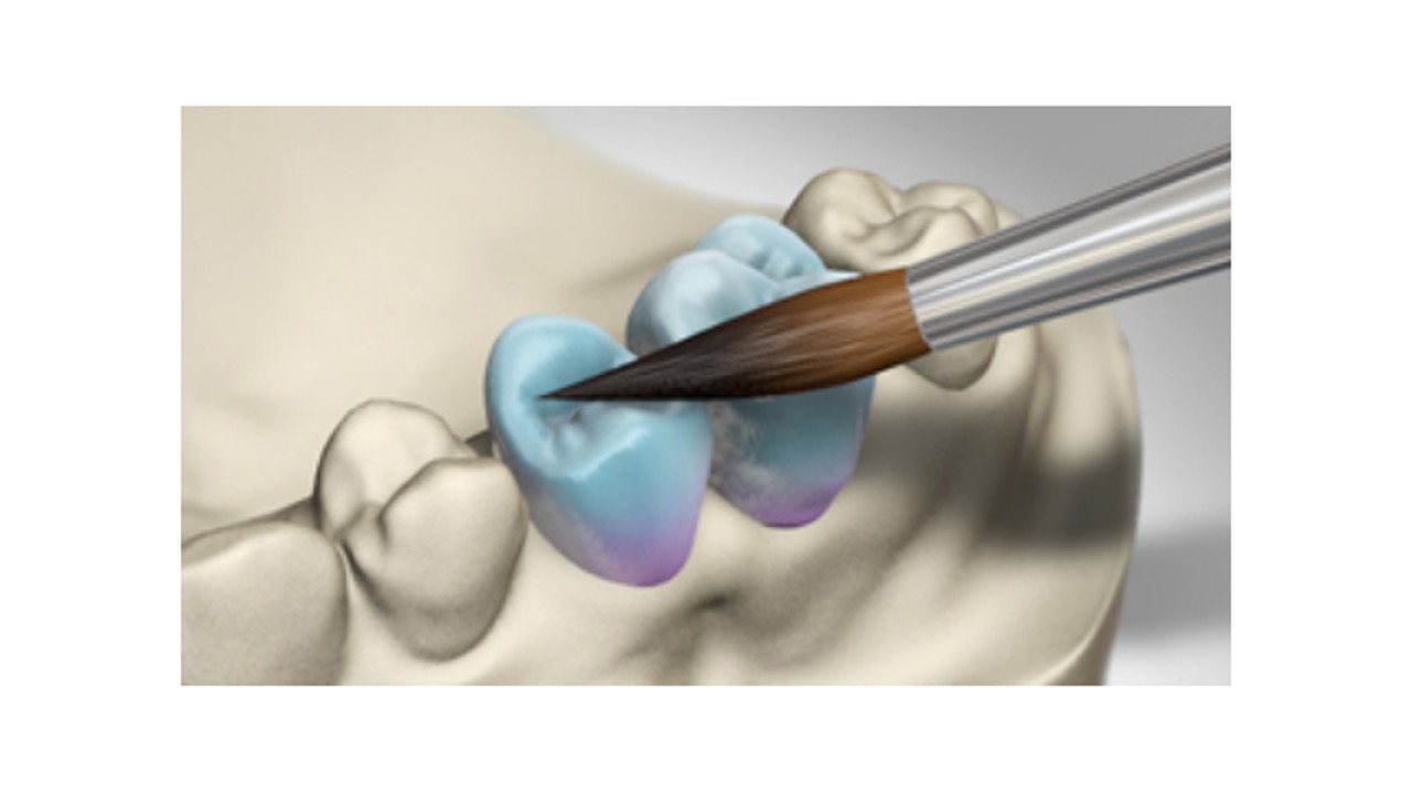 Veneer Porselenleri