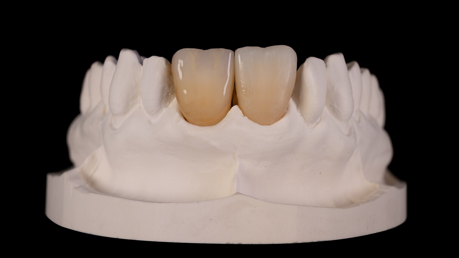 Creating transparency and contrast in incisal area