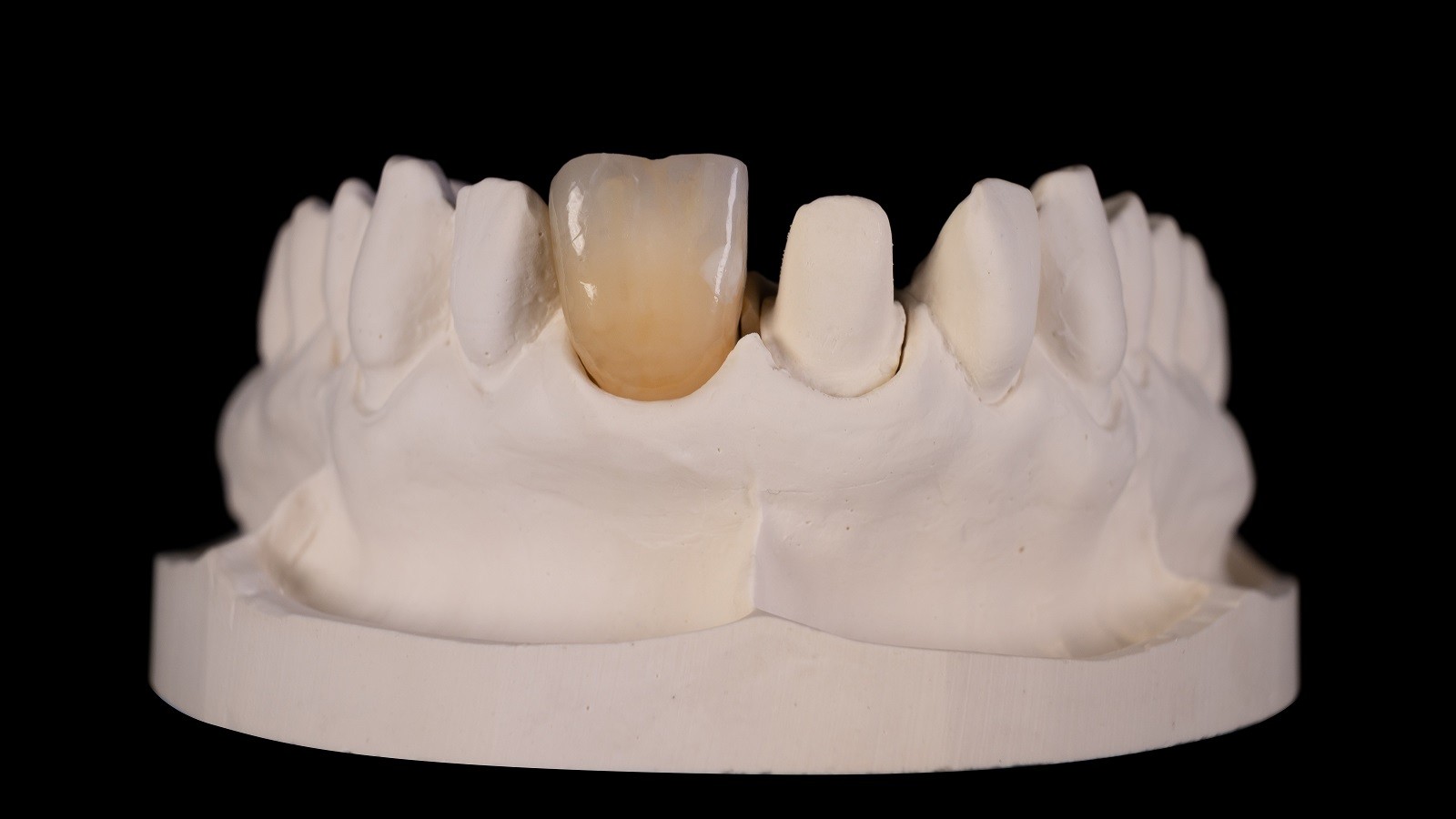 Increased Enamel cracks and lime spot